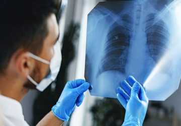 How To Reduce Your Risk Of Developing Lung Cancer