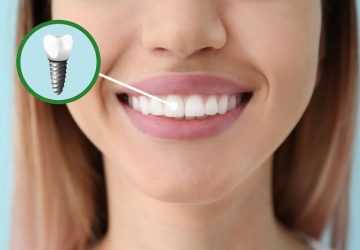 How To Choose The Right Material For Your Dental Implants
