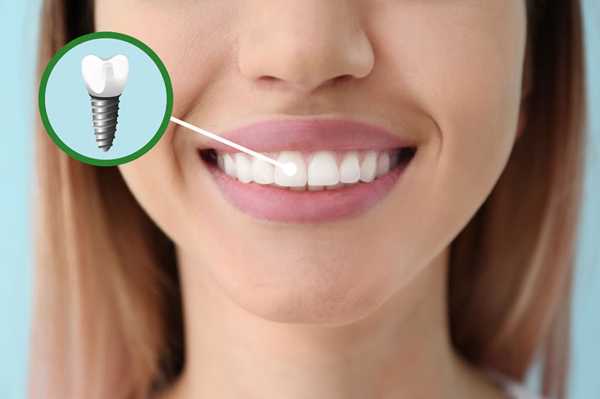 How To Choose The Right Material For Your Dental Implants