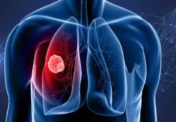 How To Recognize The Early Symptoms Of Lung Cancer