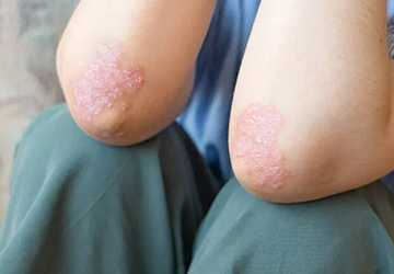 Psoriasis: From Incurable to Hopeful