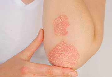 Psoriasis No More: Revolutionary Treatment Eradicates Skin Condition