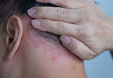 What You Didn't Know About Psoriasis