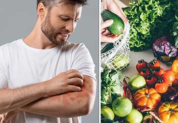 Diet and Psoriasis: The Role of Nutrition in Treatment
