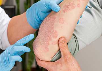 Psoriasis: The Skin Condition That Could Be Killing You